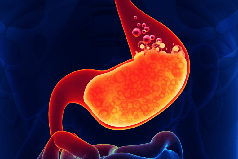 GERD: Treat it with a low- or high-carb diet